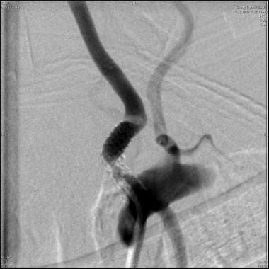 Vertebral stent fracture with in-stent restenosis.