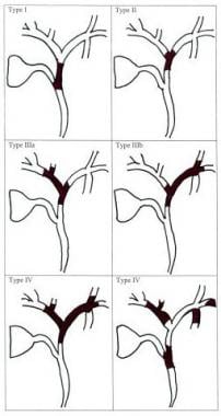 klatskin tumor stages of