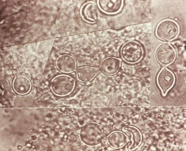 blastomycosis histology