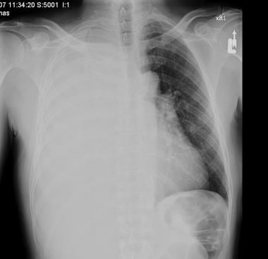 pleural effusion