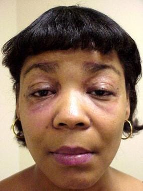 Heliotrope rash in a woman with dermatomyositis. 