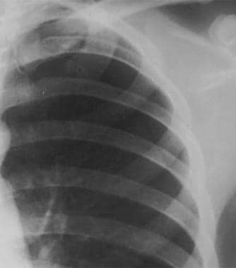 Close radiographic view of a patient with spontane