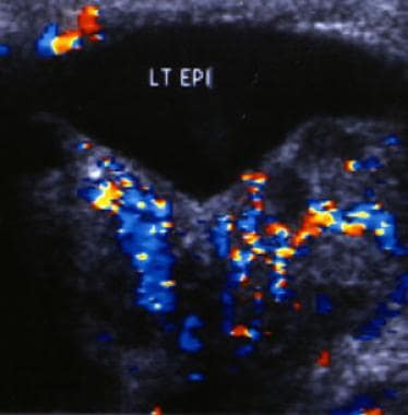 左附睾彩色多普勒超声图