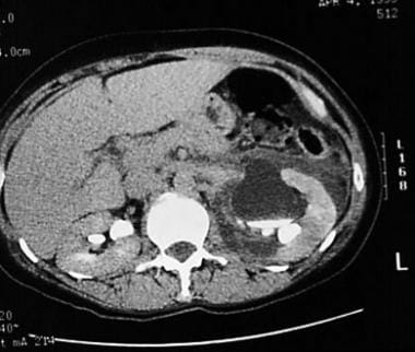 CT scan with intravenous contrast demonstrating po