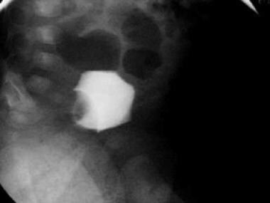 排尿膀胱尿道造影显示右侧