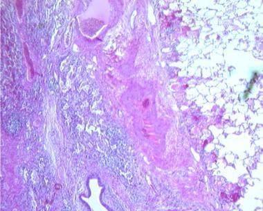 Histology of a lung abscess shows dense inflammato