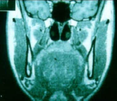 Coronal MRI. 