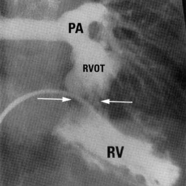 Right anterior oblique (RAO) angiogram demonstrati