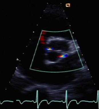Parasternal short-axis echocardiographic view in d