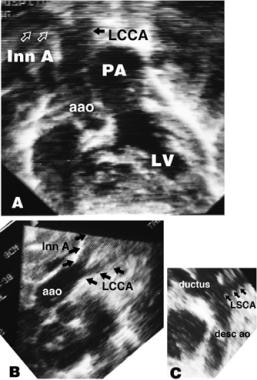 A部分描绘了潜伏的额椅echocardiogr