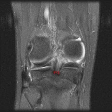 This MRI (coronal section) shows a posterior cruci