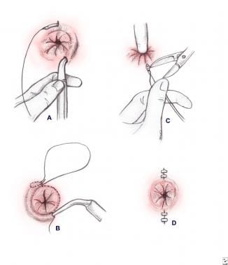 Thiersch procedure. Perianal subcutaneous sutures 
