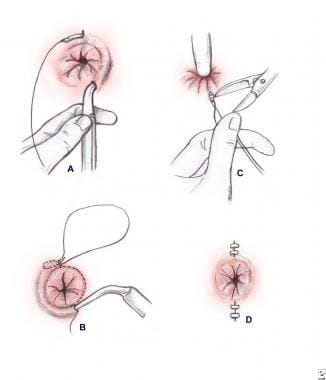 Pediatric Rectal Prolapse Treatment & Management: Approach Considerations, Manual Reduction, Conservative Management