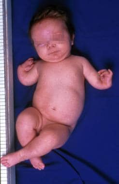 Infant with thrombocytopenia-absent radius syndrom