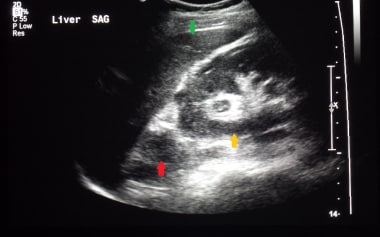 A case of early right adrenal carcinoma (red arrow