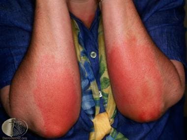 Delayed pressure urticaria. Courtesy of DermNet Ne