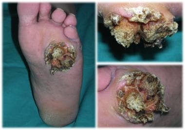 Verrucous carcinoma; an exophytic and hyperkeratot