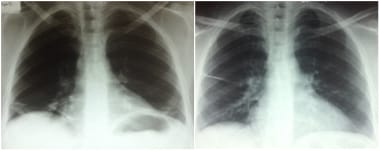 Radiograph of a patient with bilateral diaphragmat