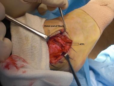 Brostrom-Gould repair. Transected anterior talofib