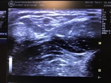 Ultrasound image of sural nerve.