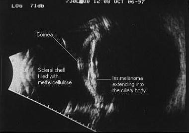 Immersion B-scan image of an iris melanoma extendi