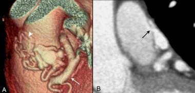 Coronary artery fistula: Volume-rendered CT image 