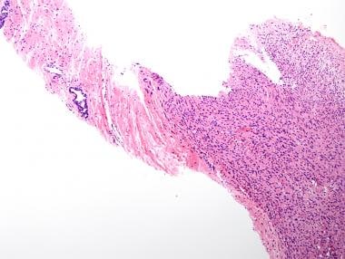 Low-power magnification of prostate core biopsy sh