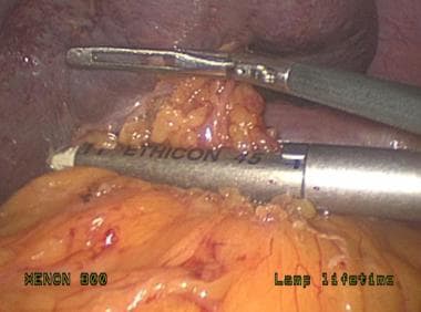 Laparoscopic splenectomy. Ligation of splenic hilu