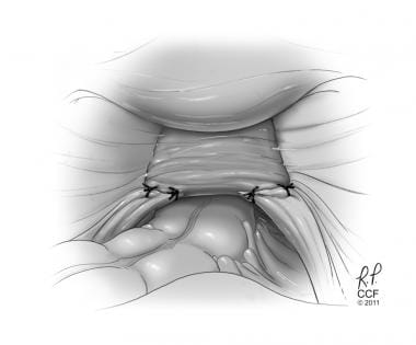 Uterosacral ligament suspension. Reprinted with pe