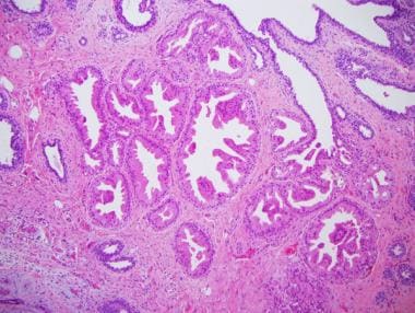 Virusi nilit. - Papillary lesion with apocrine metaplasia