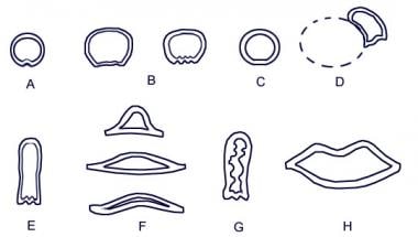 Cross-sectional shapes of the trachea. A: Juvenile