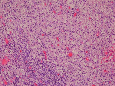 Xanthogranulomatous前列腺炎。泡沫床单