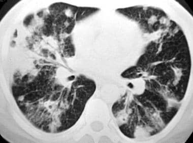 Chest CT image of pulmonary coccidioidomycosis. (C