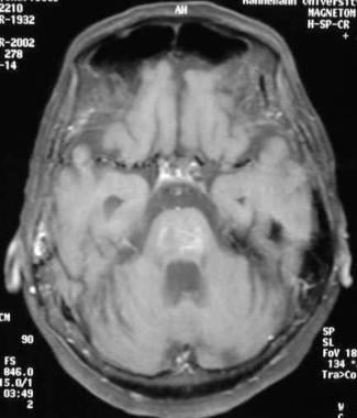 Axial enhanced T1-weighted MRI demonstrates the ty