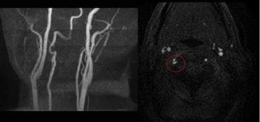 3D time-of-flight (TOF) of the neck axial and MIP 