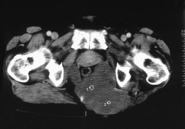Computed tomography scan. Recurrence of a sacrococ