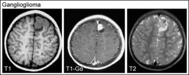 Axial magnetic resonance images (T1-weighted, T1-w