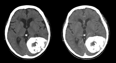 Transverse axial CT without and with contrast demo