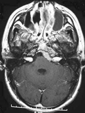 Neurofibromatosis Type 2 Imaging: Practice Essentials, Radiography ...