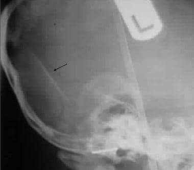 Lateral skull radiograph in a child shows an occip
