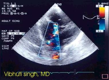 Atrial septal defect is demonstrated using color D