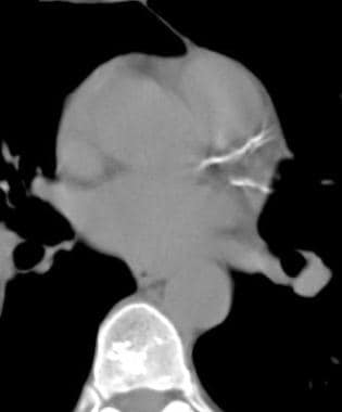 Coronary artery calcification - CT. Image obtained