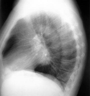 Bronchogenic cyst. Conventional radiograph demonst