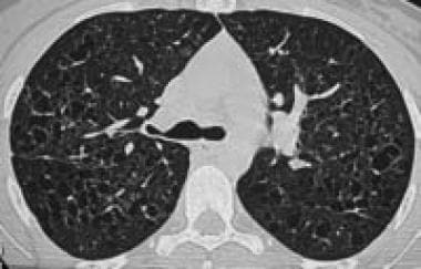 High-resolution chest CT scan in a patient with ad