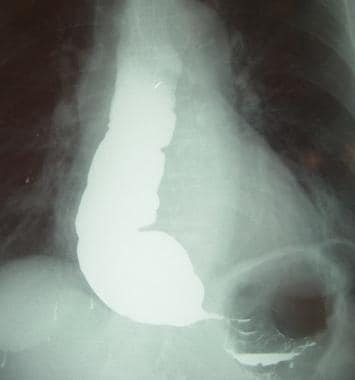 Barium swallow study demonstrating characteristics