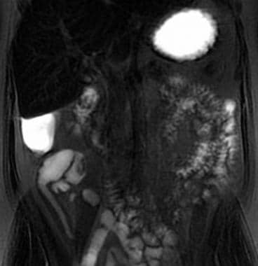MRI小肠造影冠状单次快速旋转技术