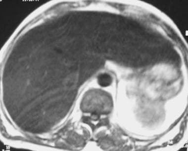 T1-weighted spin echo image in a 47-year-old man w