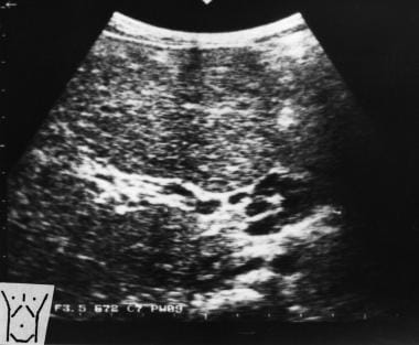 Transverse sonogram of the liver in a patient with