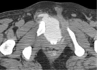 Urethra, trauma. CT scan shows extravasation of co