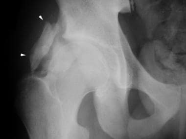 Anteroposterior radiograph of the right hip in a 1